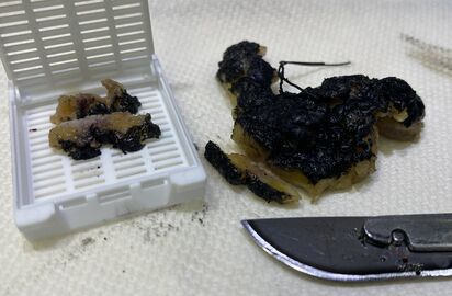 Re-excisions are subsequently serially sectioned perpendicularly to the new margin (to be able to measure distance from any tumor to the new margin). For large specimens, every other section may be submitted.