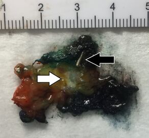 Invasive ductal carcinomas generally appear grossly as tan-white firm areas, here seen (white arrow) on a slice with inked margins. A radioactive seed (black arrow) was inserted by radiology to locate the tumor.