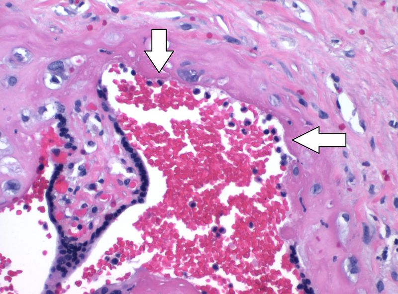 File:Insignificant intervillous neutrophils, annotated.jpg