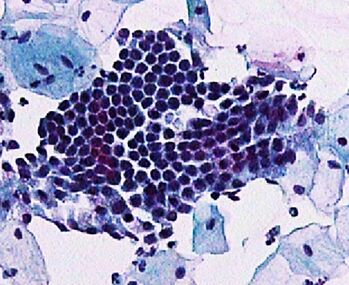 Sheets of endocervical cells have a honeycomb pattern.