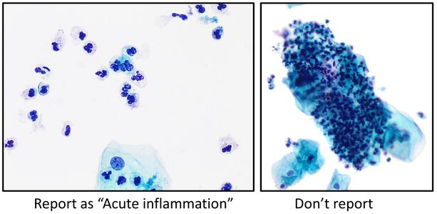 For reporting, acute inflammation should be a background of ample dispersed neutrophils, and not only aggregates of neutrophils with cells or mucus.