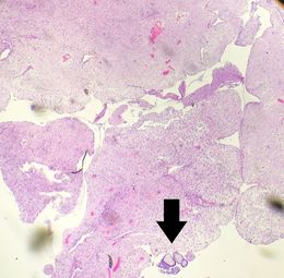 Products of conception, with chorionic villi (arrow) among decidualized endometrium