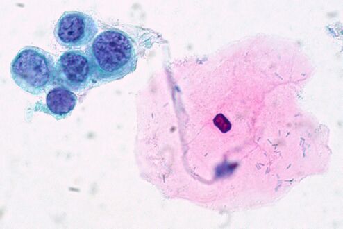 High-grade squamous intraepithelial lesion (HSIL), showing even more prominent features, and decreased cytoplasm, causing a high nuclear/cytoplasmic ratio.