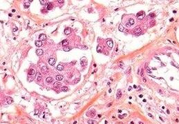 If unsure whether a case is true lymphovascular invasion or a retraction artifact (imaged), use immunohistochemistry for D2-40 to highlight lymphatic vessels or CD-31 for blood vessels.